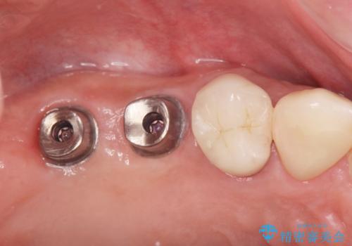 奥歯でしっかりと咬みたい　咬合機能をしっかりと回復するインプラント治療の治療中