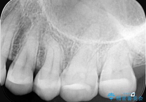 奥歯の痛みを根本から解消し、クラウンで歯の強度を回復の治療前
