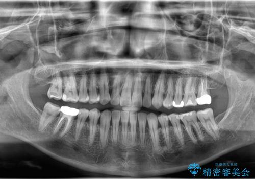 すきっ歯・切端咬合・空隙歯列|インビザラインで11ヵ月で治療完了の治療後
