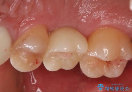 歯を入れたい　インプラント+セラミッククラウンの治療後