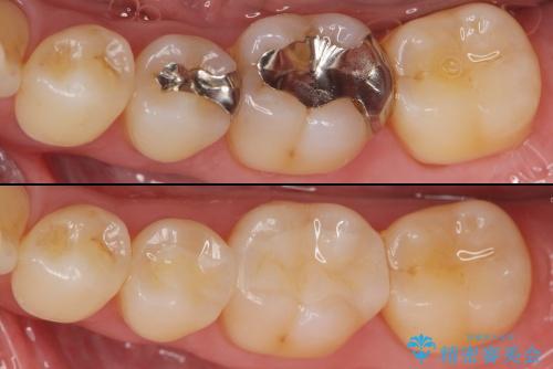 銀歯を外してのセラミック治療