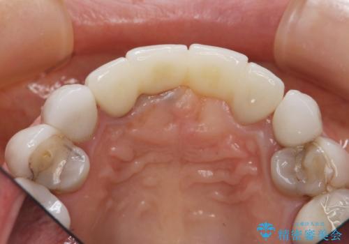 [ セラミック治療 ]  歯ぐきの際の黒ずみを改善したいの治療後