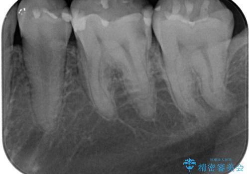 左下が虫歯になっている気がする　オールセラミッククラウンの治療前