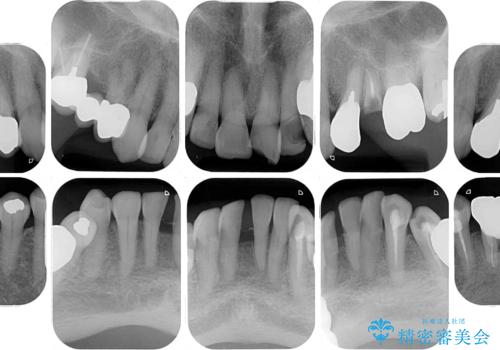 長年気になっていた前歯　矯正治療と補綴治療による審美歯科治療の治療前
