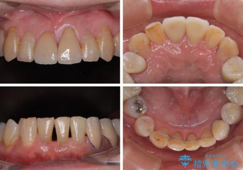長年気になっていた前歯　矯正治療と補綴治療による審美歯科治療の治療後