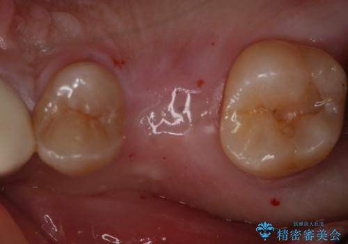 歯を入れたい インプラント+セラミッククラウンの治療前