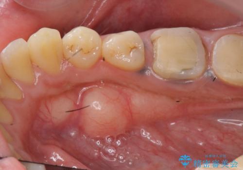 { 歯周外科 } 骨隆起除去を含む歯冠長延長術の治療中