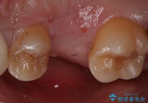 歯を入れたい インプラント+セラミッククラウンの治療前