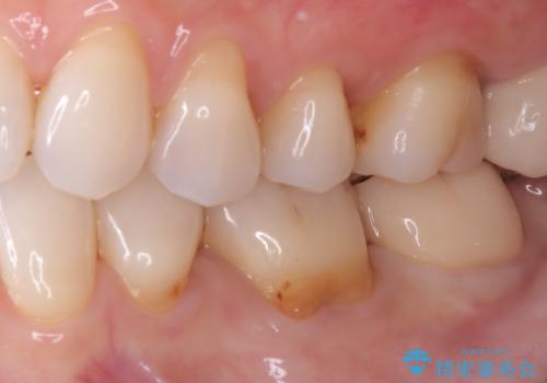 【セラミッククラウン】【生活歯髄療法】歯に穴が空いているの治療後