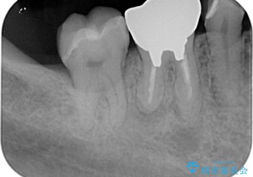 銀の詰め物を白くしたいの治療後