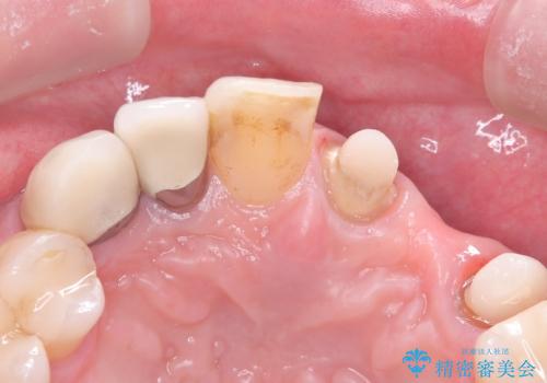 【セラミッククラウン】【エクストリュージョン】抜歯はしたくないの治療中