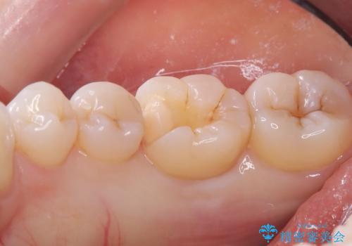 【セラミックインレー】歯がたまーにしみるの治療中