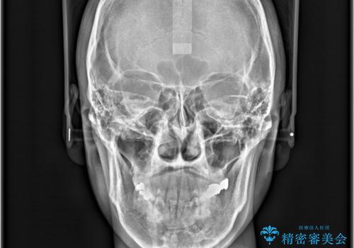 正中離開・クロスバイト・すきっ歯・叢生|インビザラインで治療の治療前