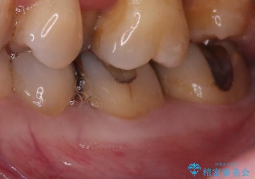 話すときに銀歯が見えて気になる セラミックでキレイに治す!の治療前