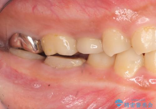 { 歯周外科 }  骨隆起除去を含む歯冠長延長術の治療前