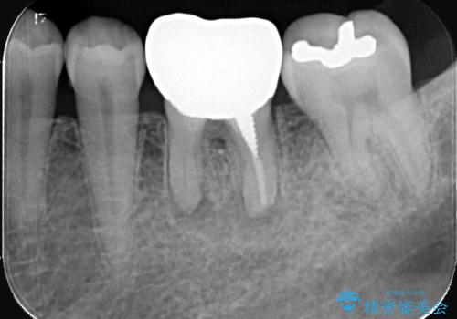根尖性歯周炎|分岐部病変|パーフォレーション|インプラントで治療の治療前