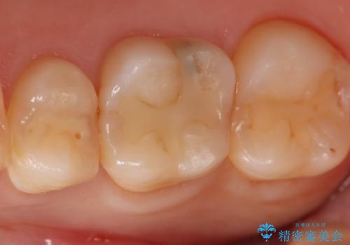 虫歯をしっかり治したい　セラミックインレーの治療前