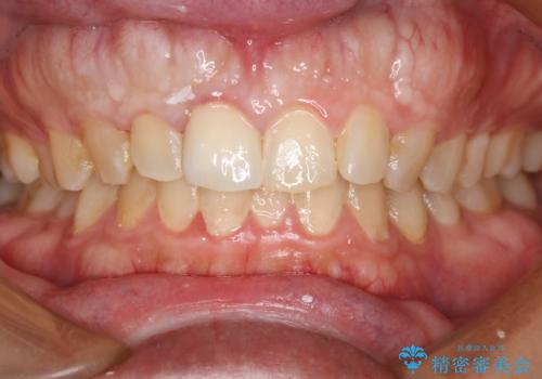 前歯が欠けたので綺麗にしたい オールセラミッククラウンの治療後