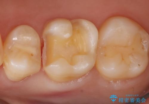 虫歯をしっかり治したい　セラミックインレーの治療中