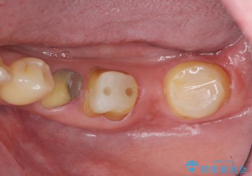 遊離歯肉移植術を併用した、破折歯のインプラント治療の治療前