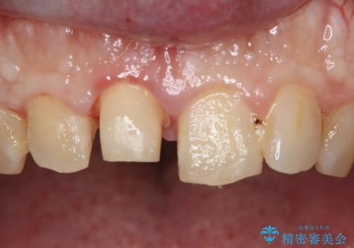 前歯が欠けたので綺麗にしたい　オールセラミッククラウンの治療中