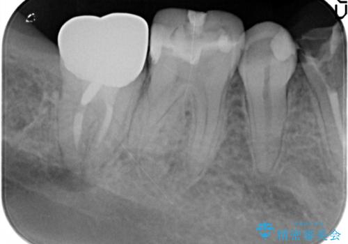すべての虫歯治療をしたいの治療前