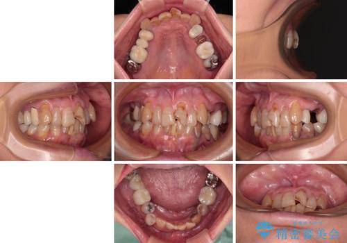 長年気になっていた前歯　矯正治療と補綴治療による審美歯科治療の治療前