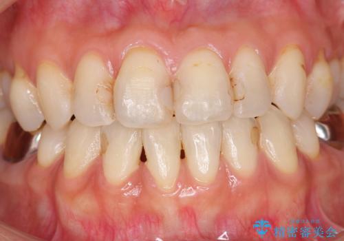 前歯の劣化したコンポジットレジン修復をセラミッククラウンへの治療前