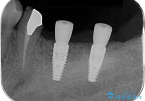 遊離歯肉移植術を併用した、破折歯のインプラント治療の治療中