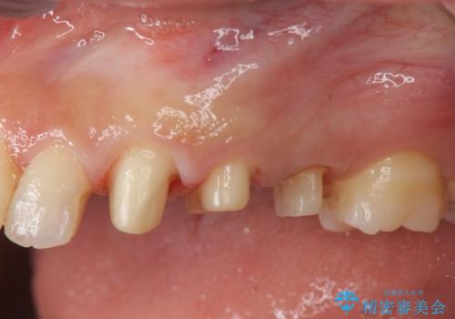 歯の水平・垂直的位置を整備したセラミッククラウン治療の治療中