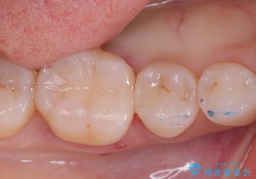 【セラミックインレー】歯がたまーにしみるの症例 治療後