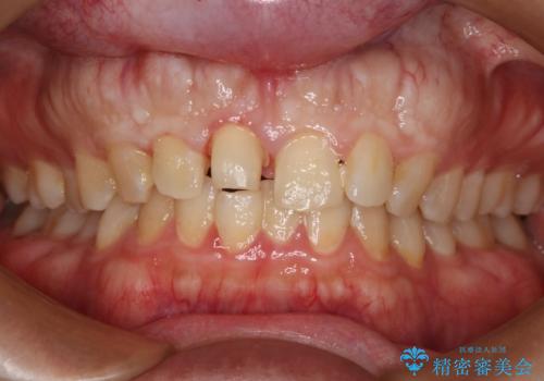 前歯が欠けたので綺麗にしたい オールセラミッククラウンの治療中