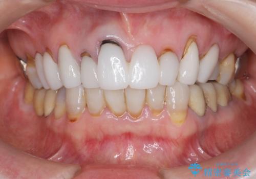 [ セラミック治療 ]  歯ぐきの際の黒ずみを改善したいの治療前