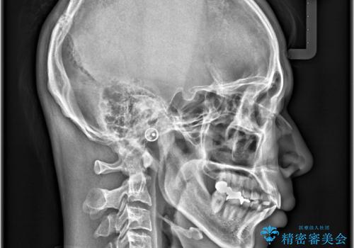 正中離開・クロスバイト・すきっ歯・叢生|インビザラインで治療の治療前