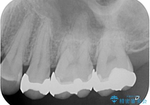 【メタルフリー】銀歯を綺麗な白い歯にの治療前
