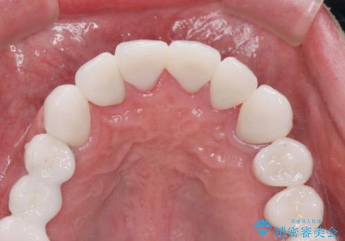 [ 歯周外科手術 ]  セラミック治療後の歯ぐきの違和感の治療後