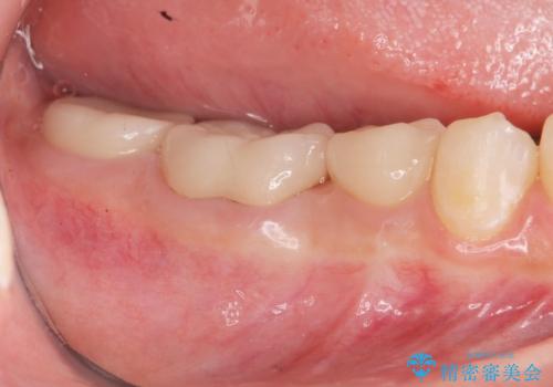 { 歯周外科 } 骨隆起除去を含む歯冠長延長術の症例 治療後