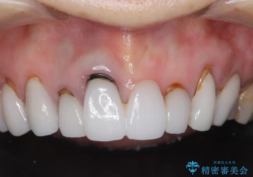 [ セラミック治療 ]  歯ぐきの際の黒ずみを改善したいの症例 治療前
