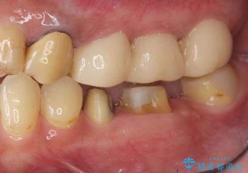 遊離歯肉移植術を併用した、破折歯のインプラント治療の治療前