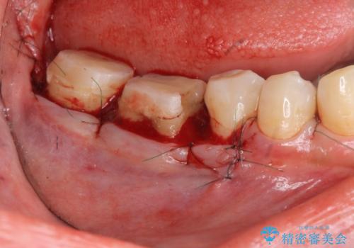 { 歯周外科 } 骨隆起除去を含む歯冠長延長術の治療中