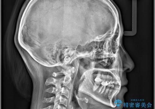 すきっ歯・切端咬合・空隙歯列|インビザラインで11ヵ月で治療完了の治療前