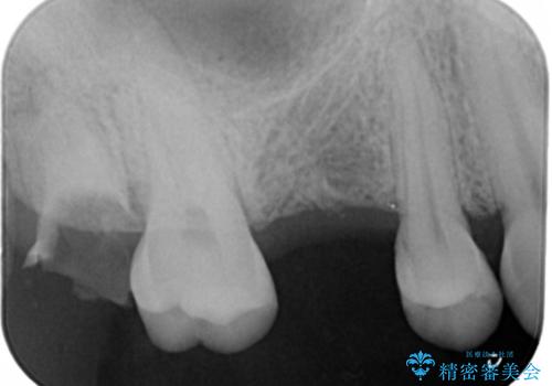 歯を入れたい　インプラント+セラミッククラウンの治療前