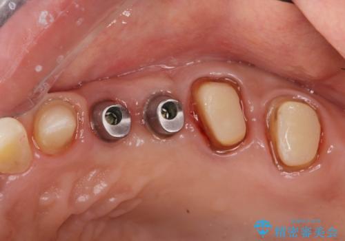 銀歯を外してのインプラント・セラミック治療の治療中