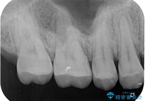 虫歯をしっかり治したい　セラミックインレーの治療前