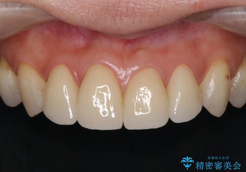 前歯の劣化したコンポジットレジン修復をセラミッククラウンへの症例 治療後