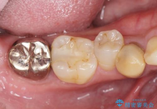 すべての虫歯治療をしたいの治療前