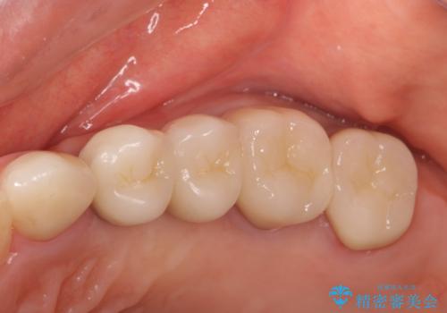 銀歯を外してのインプラント・セラミック治療の治療後
