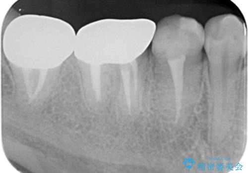{ 歯周外科 } 骨隆起除去を含む歯冠長延長術の治療後
