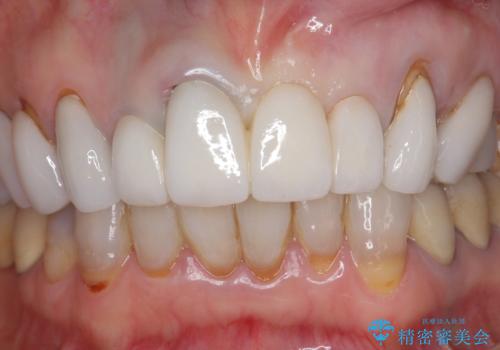 [ セラミック治療 ]  歯ぐきの際の黒ずみを改善したいの治療後