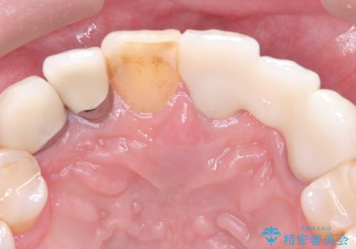 【セラミッククラウン】【エクストリュージョン】抜歯はしたくないの治療後